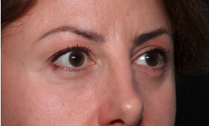 Blepharoplasty and Brow Lift Before & After Patient #34363